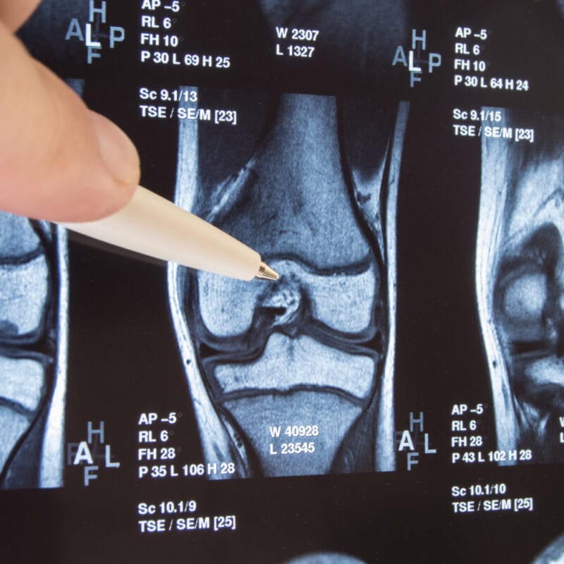 Knee xray closeup for treatment timelines